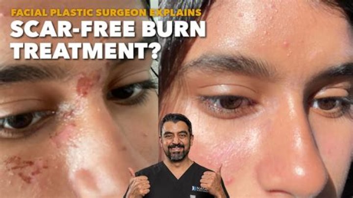 What Happened To Savitars Face In The Flash | Burn Scar Mark Reason